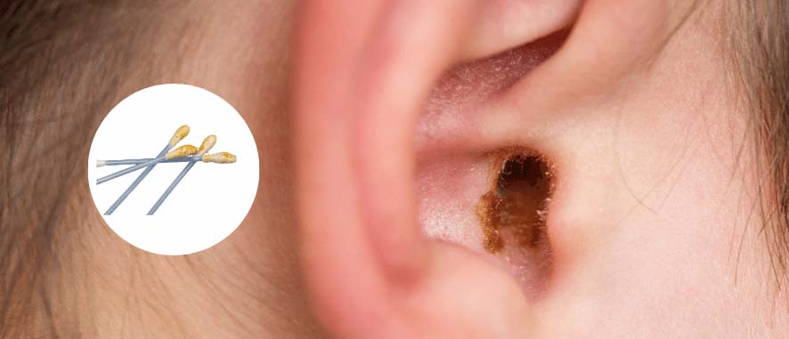 Understanding the Importance of Regular Wax Filter Replacement in Hearing Aids | Aanvii Hearing